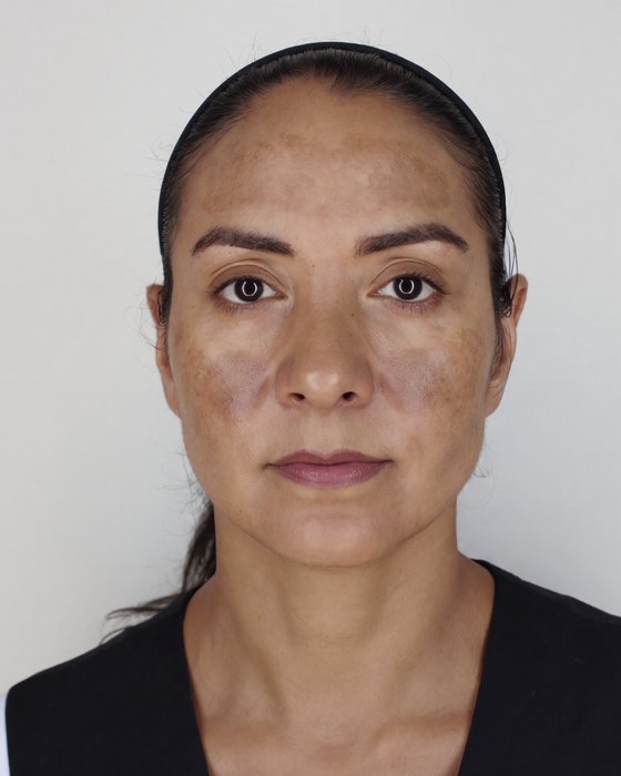 Week 0: melasma across the forehead and both cheeks