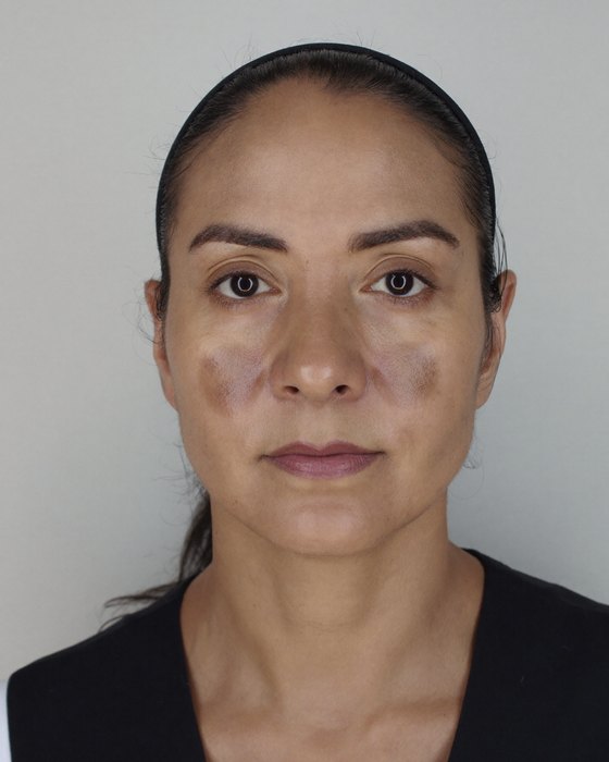 Week 0: early melasma on both cheekbones