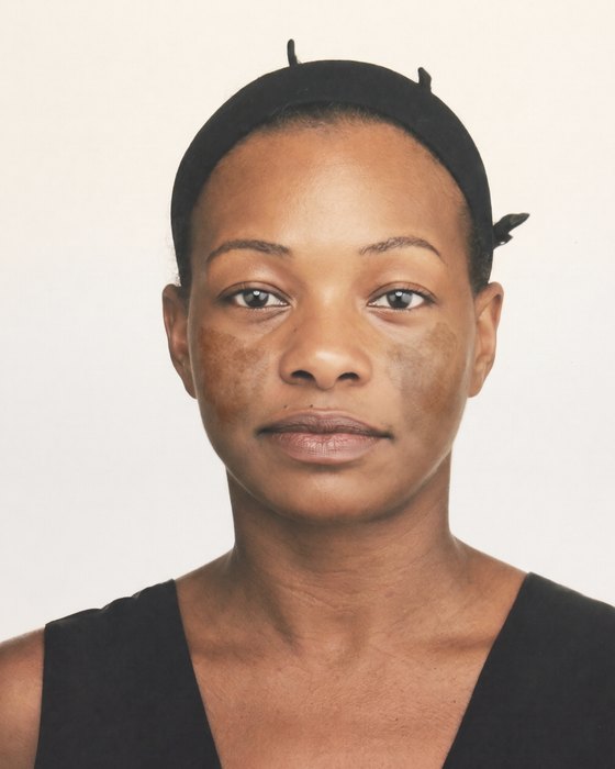 Week 0: melasma on both cheeks spreading to the temples
