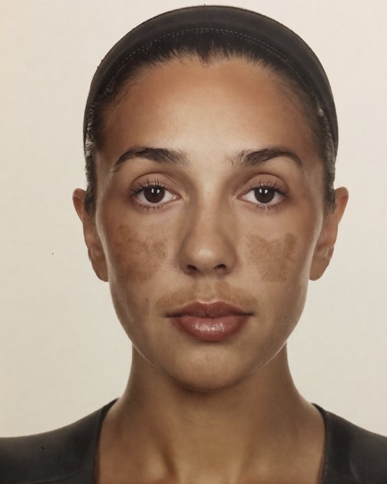 Week 0: melasma on the cheekbones and upper lip